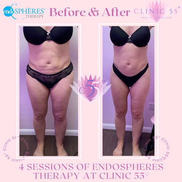 Before & After 4 Sessions of Endospheres Therapy